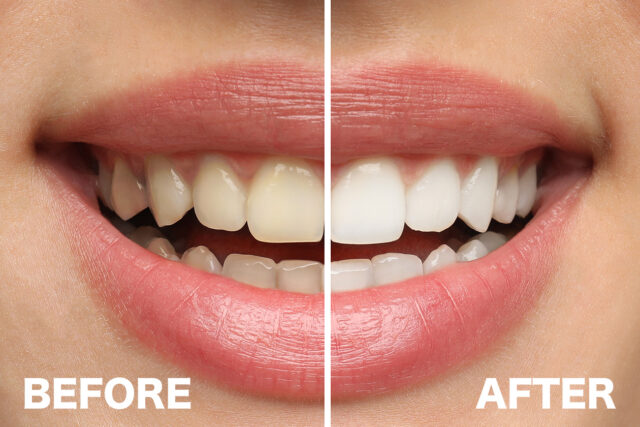 ホワイトニング